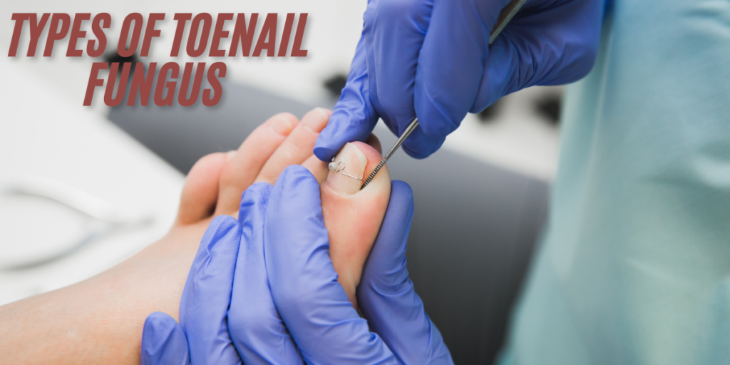 Shocking Types of Toenail Fungus You Need to Know About