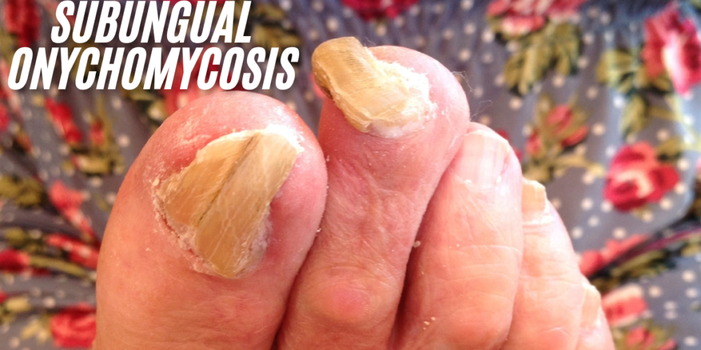 Subungual Onychomycosis