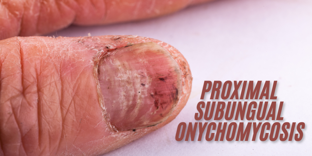 Proximal Subungual Onychomycosis