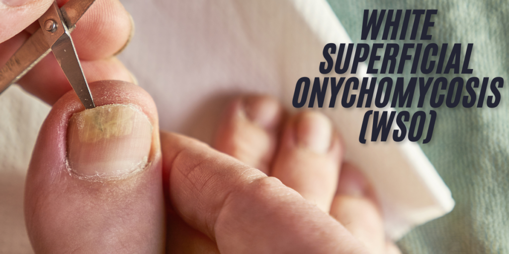 White Superficial Onychomycosis (WSO)