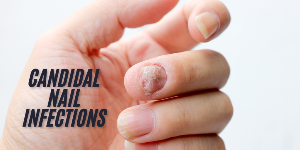 Candidal Nail Infections