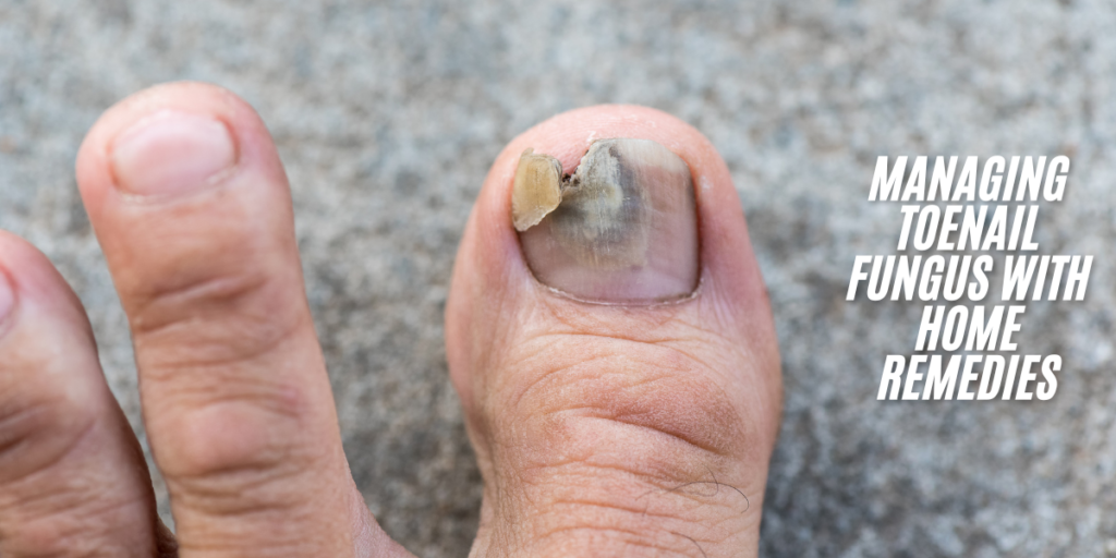 Managing Toenail Fungus with Home Remedies