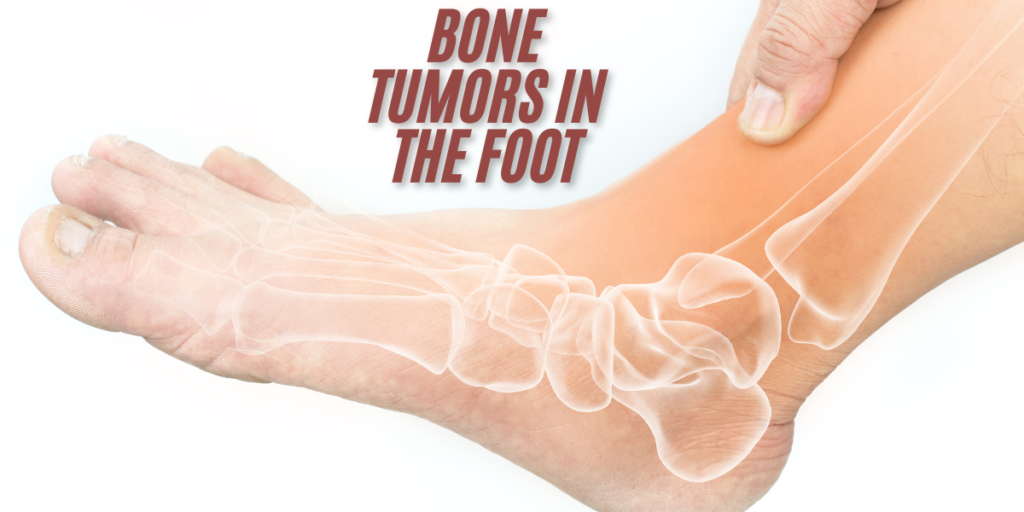 Bone Tumors in the Foot