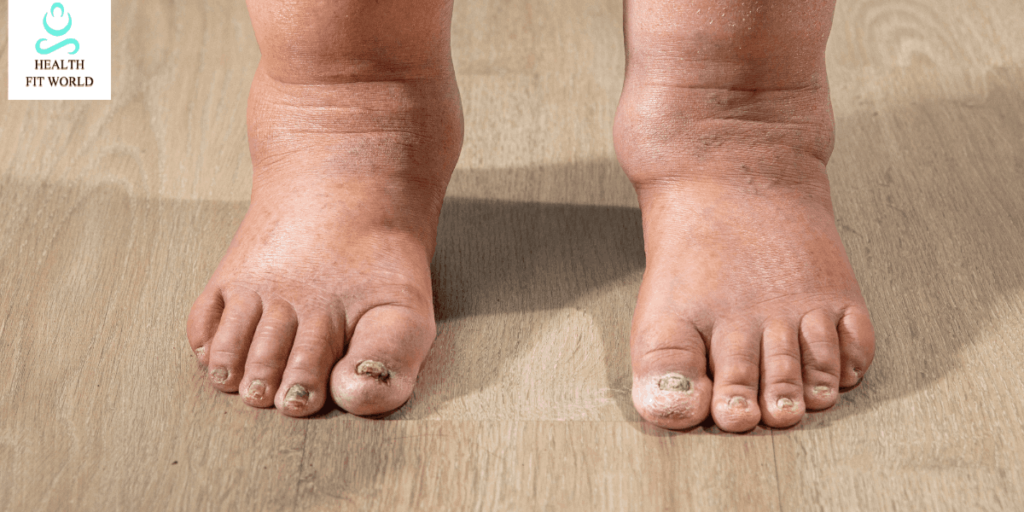 Why Feet Swell in Diabetes