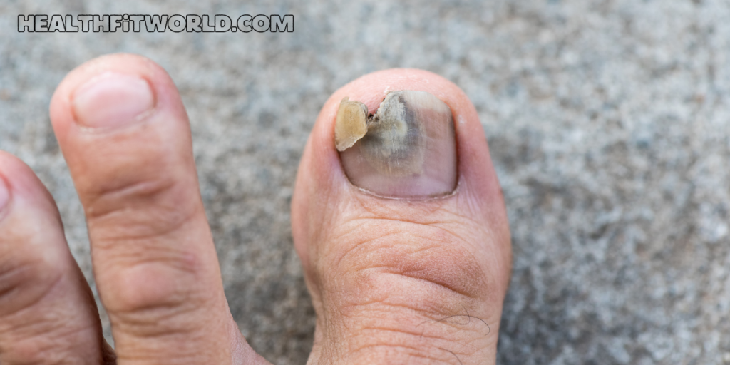 What Kills Toenail Fungus Instantly? Discover the Miracle Cure!